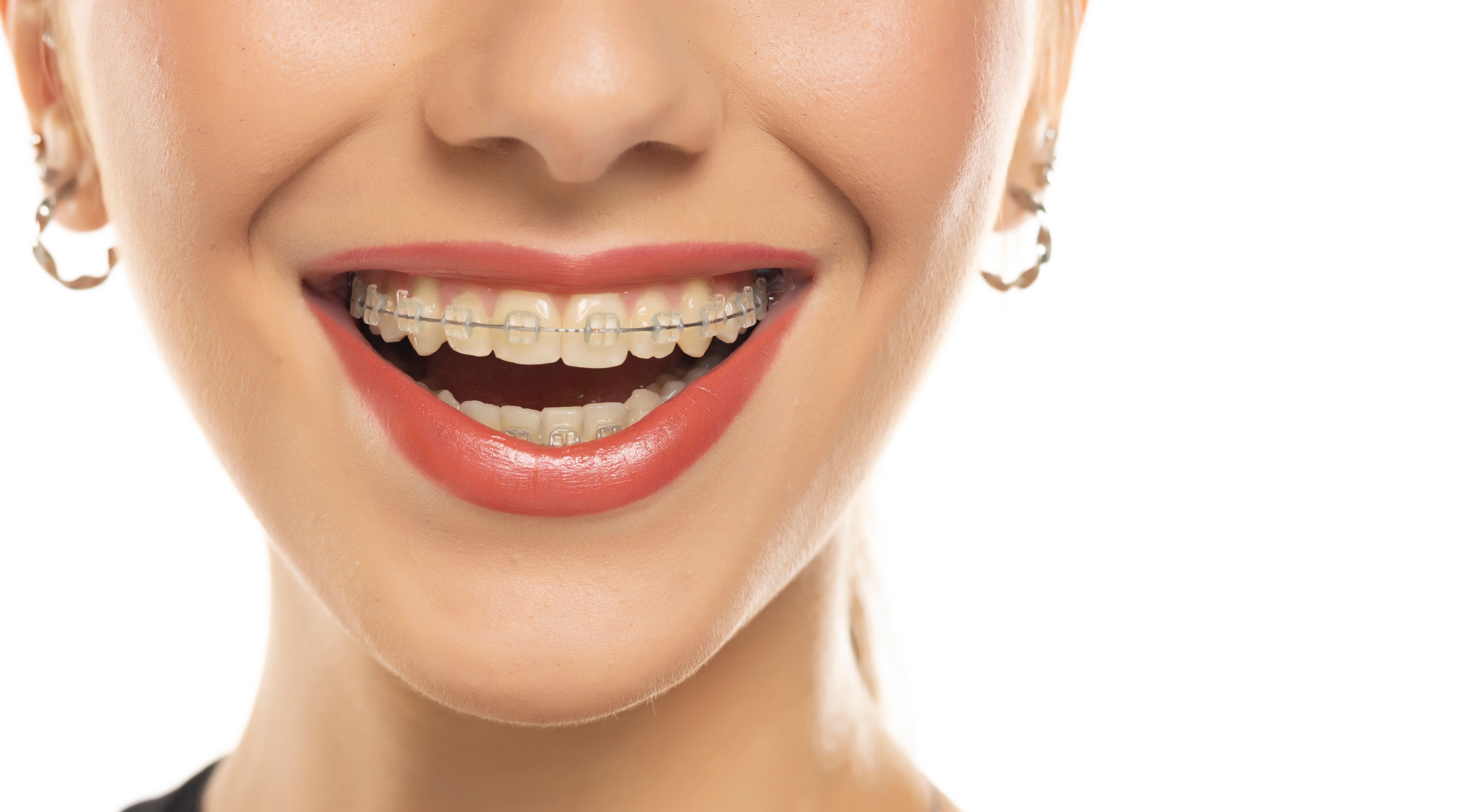 Clear braces; Invisalign